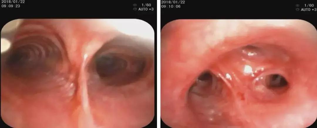 青年男性肺炎过后一直咳嗽怎么办,潜伏结核感染咳嗽咳痰