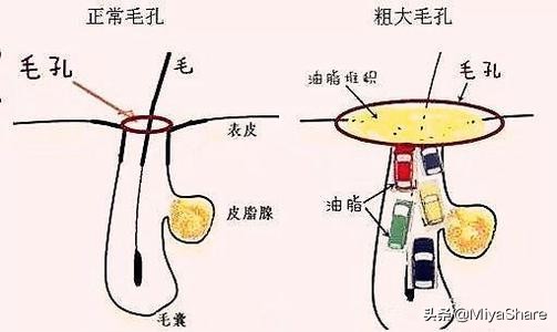 痘肌用洗面奶洗脸是不是长痘,长痘肌应该频繁用洗面奶洗脸吗