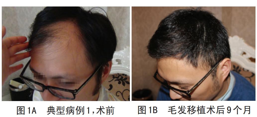 脱发掉发秃顶你该了解生发方法了,男士脱发秃顶怎么才能长出头发