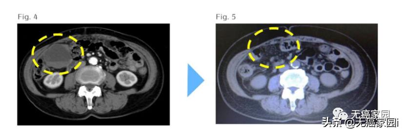 诺贝尔医学奖治疗癌症,诺贝尔医学奖治愈癌症