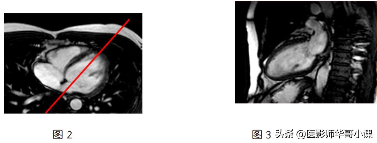 磁共振心脏扫描标准切面,心脏mri扫描定位