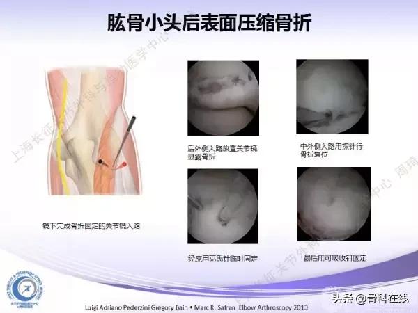 肘关节镜手术后引流,肘关节镜微创手术
