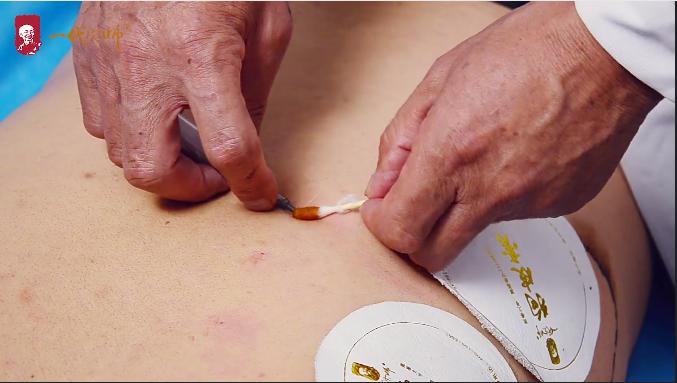 肩周炎、颈椎病、腰间盘突出怎么办？独家手法视频免费领