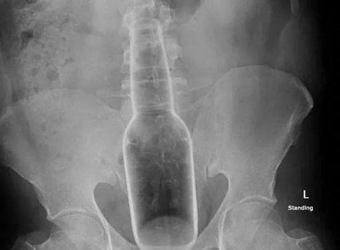 男子将18厘米长花露水瓶塞进肛门，原因令人哭笑不得