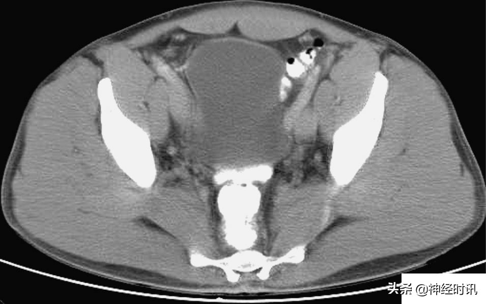 肾脏输尿管膀胱前列腺结构,肾输尿管膀胱解剖示意图