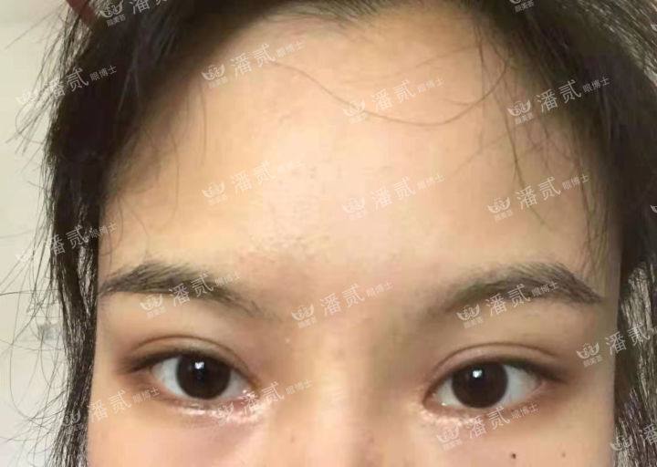 女孩眼部整形失败,内眼角整形失败