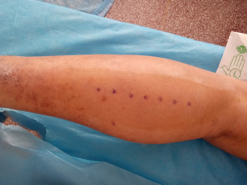 足跟痛最好的治疗方法视频,足跟痛的最好治疗办法