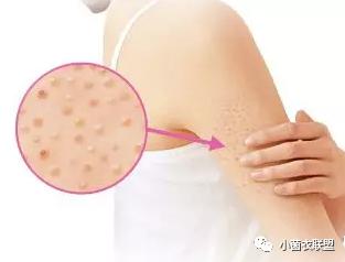 毛囊旁边长了小疙瘩不痛不痒,毛囊上肉疙瘩