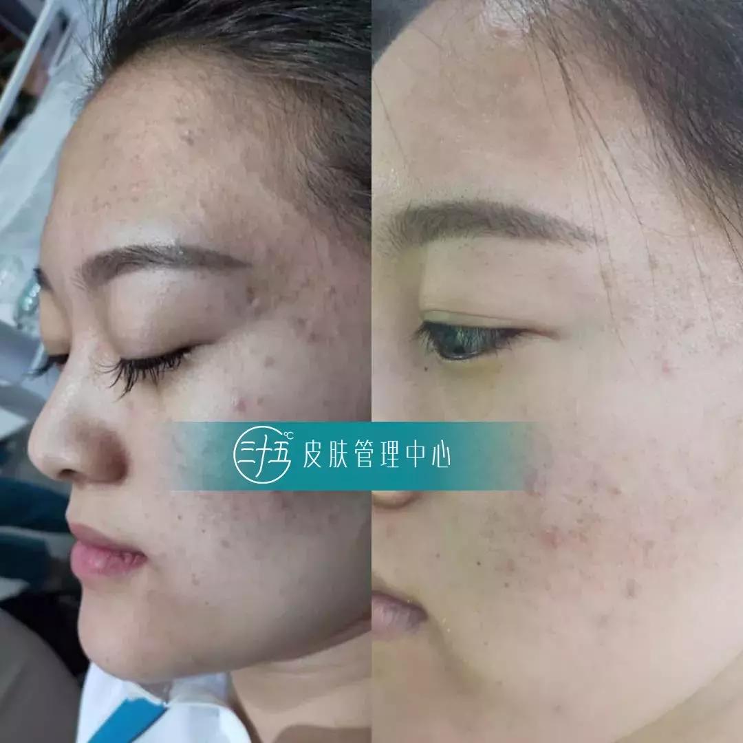 痘痘反反复复试试这招祛痘不用愁,青春期去除痘痘最有效的祛痘神器