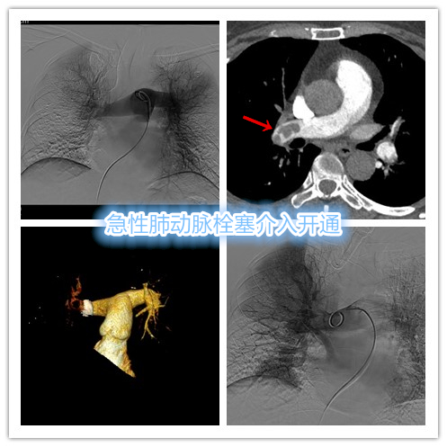 急性肺栓塞的中医操作,肺栓塞微创介入取栓