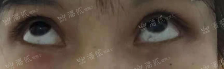 女孩眼部整形失败,内眼角整形失败