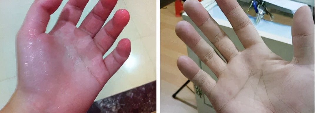 根治手汗的手术,微创治疗手汗症谁都适合么