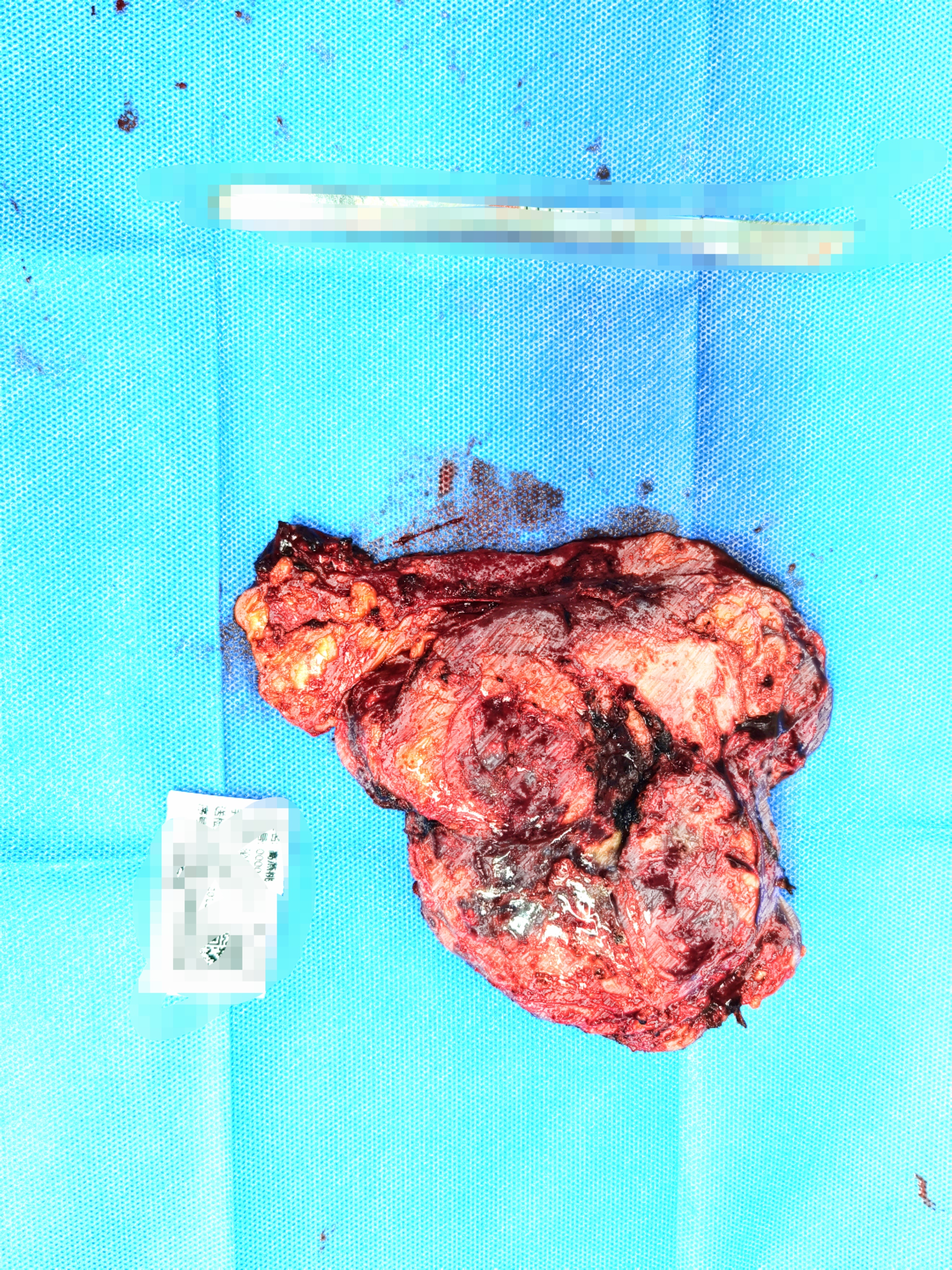 泌尿肿瘤mdt是什么意思,泌尿系肿瘤mdt专家共识