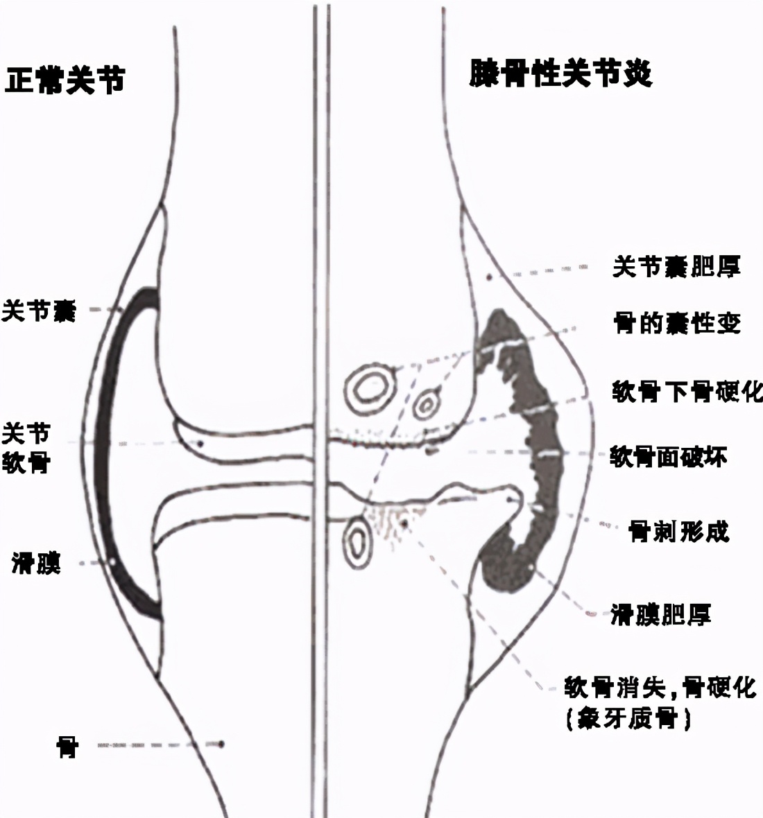 骨关节炎用什么理疗好,骨关节炎用啥药