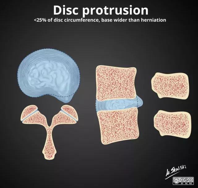 椎间盘脱出和突出片子怎么看,椎间盘膨出的鉴别诊断