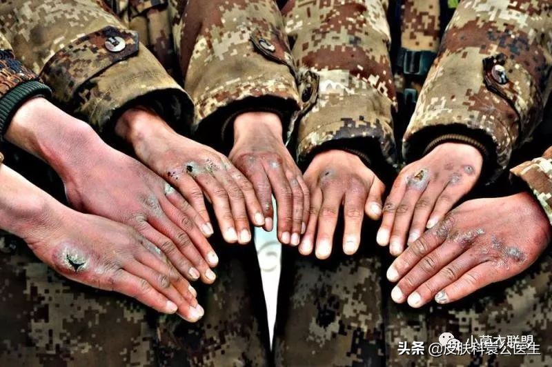 冻伤后痒痒是怎么回事,冻伤瘙痒