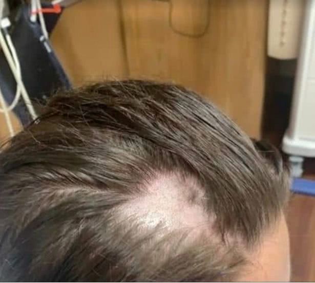 某大牌洗发水中被混入脱毛膏,女子用完头发全掉光