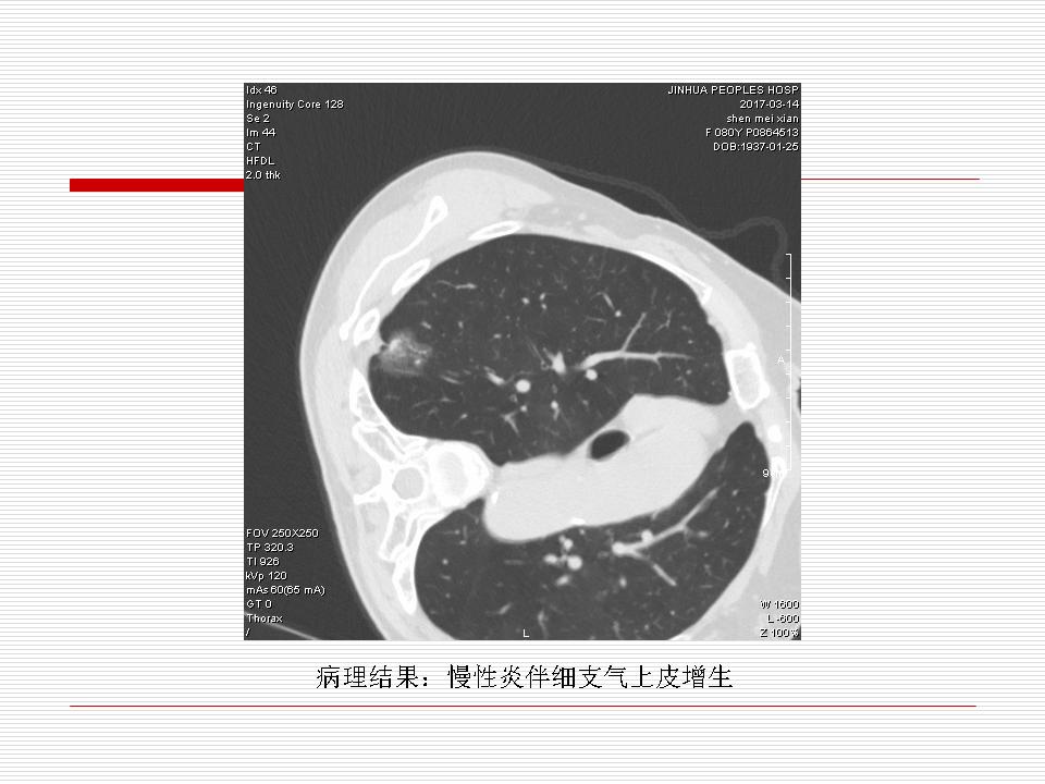 像炎症的肺癌能治好吗,医生说可能是肺癌也可能是炎症