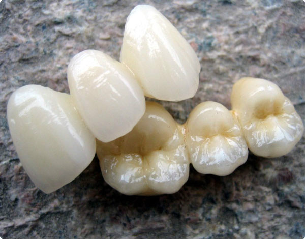 现在最便宜的假牙多少钱一颗,目前国内最好的假牙是多少钱