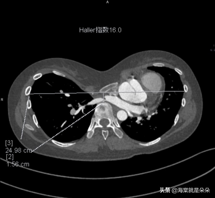 先天漏斗胸跟心脏不好有关吗,成年人漏斗胸压迫心脏