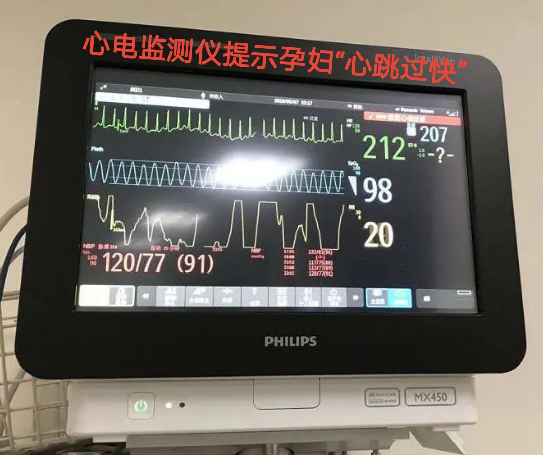孕妇心动过速外加有点心肌缺血,怀孕心电图窦性心动过速心慌胸闷
