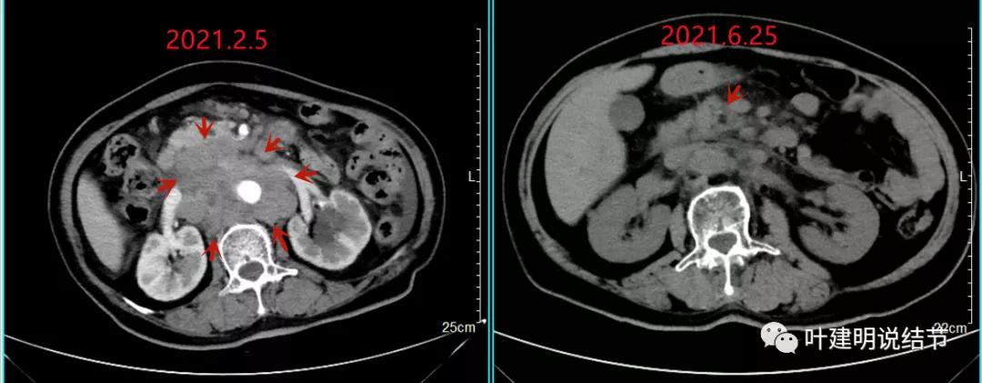 特瑞普利单抗食管癌成功案例,特瑞普利单抗治疗食管癌效果好吗
