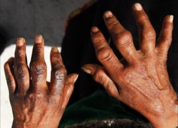 湿痹原因,湿痹症状