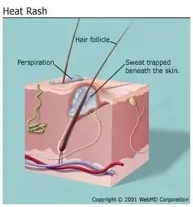 宝宝身上红点点是湿疹么,宝宝起湿疹和热痱子怎么区分