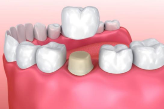 全瓷牙和烤瓷牙性价比哪个好,全瓷牙贵还是全瓷贴面贵