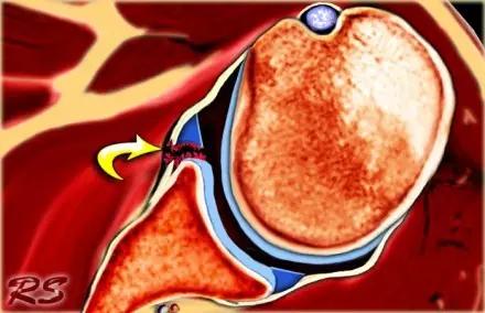 几种严重骨折医学名称,常见的骨折有哪些名称