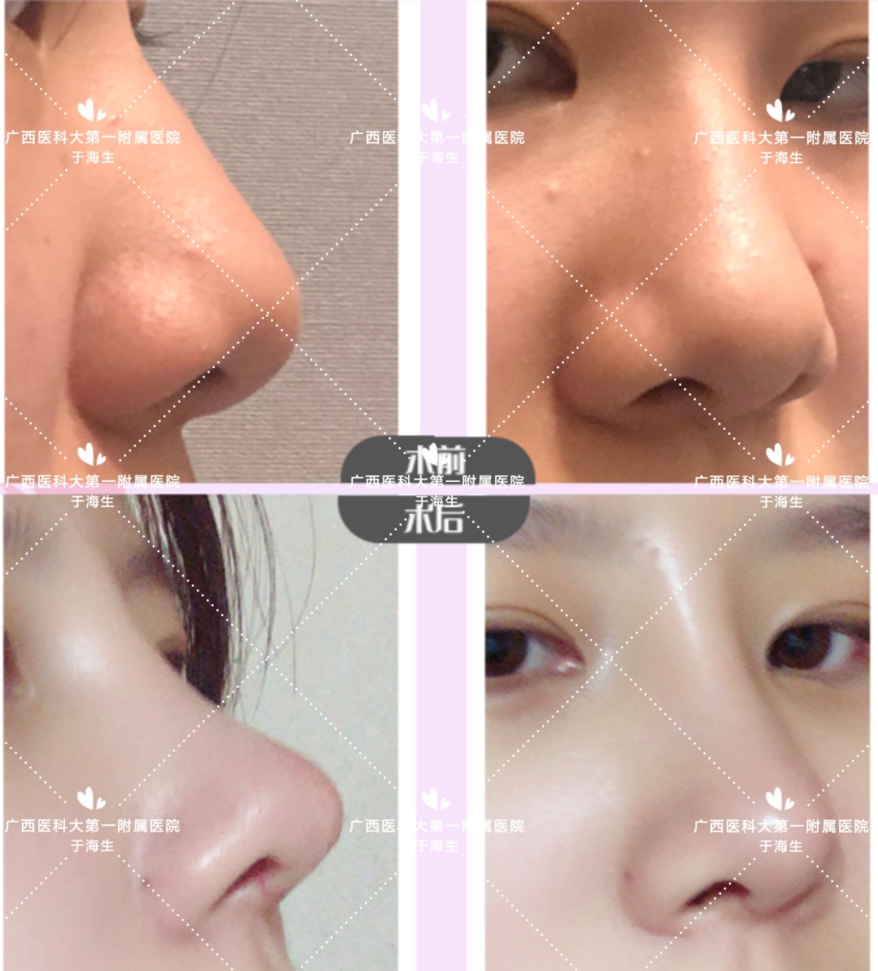 单纯缩鼻翼缩小鼻孔要怎么做,单纯的鼻翼大缩鼻翼有效果吗