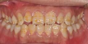 牙齿美白选什么洗牙方式,洗牙美白一般去哪里