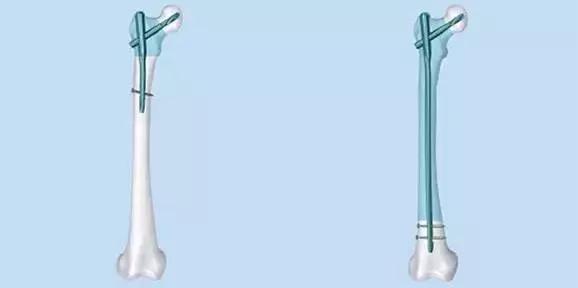 pfna主钉的选择,pfna锁定钉静态与动态区别