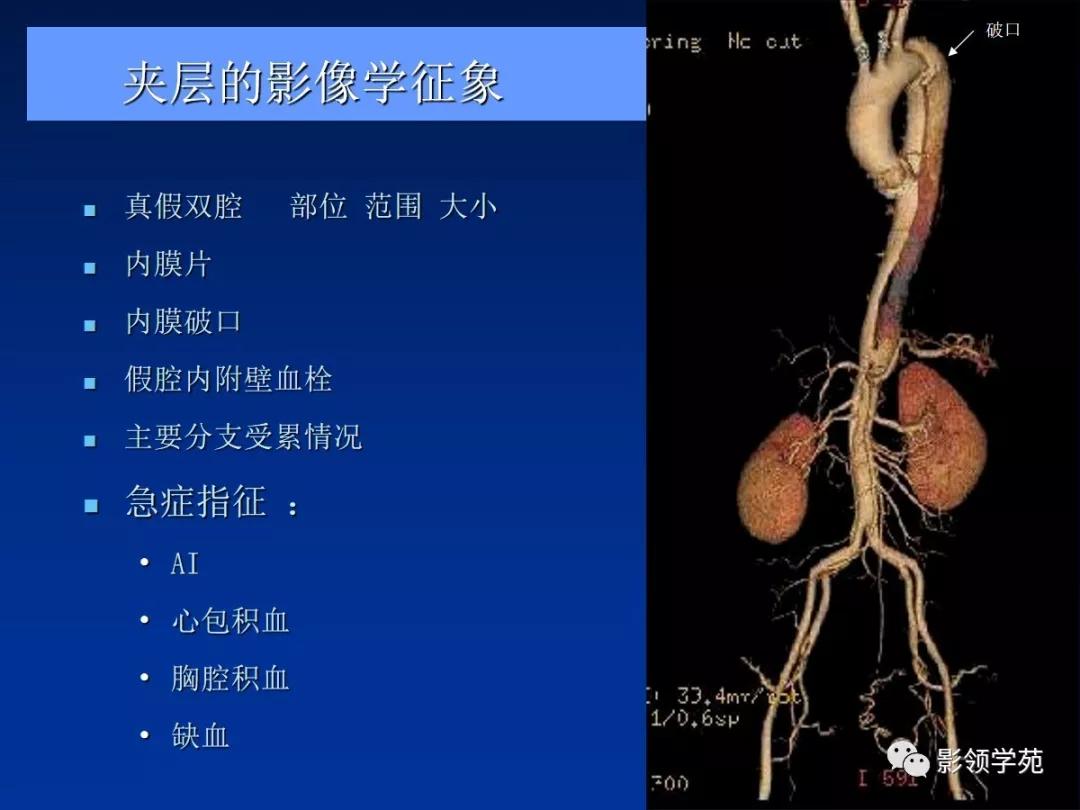 主动脉夹层壁间血肿如何鉴别,主动脉夹层血肿溃疡