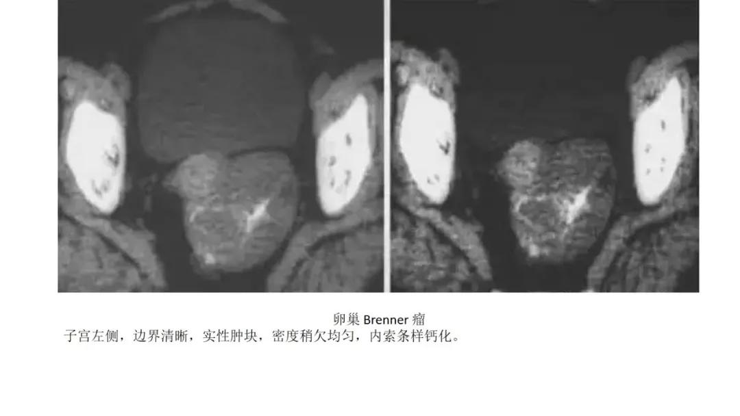 卵巢原发肿瘤的分析思路