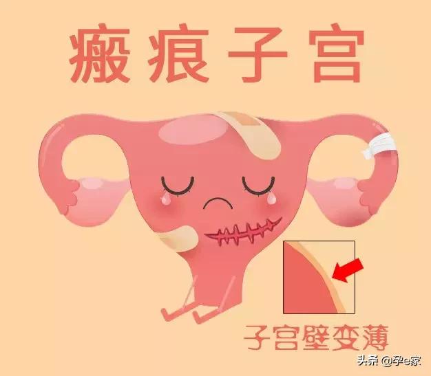 剖宫产一次比一次痛,剖宫产受罪为什么还有人剖