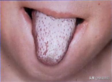 猩红热防控知识,呼吸道健康科普