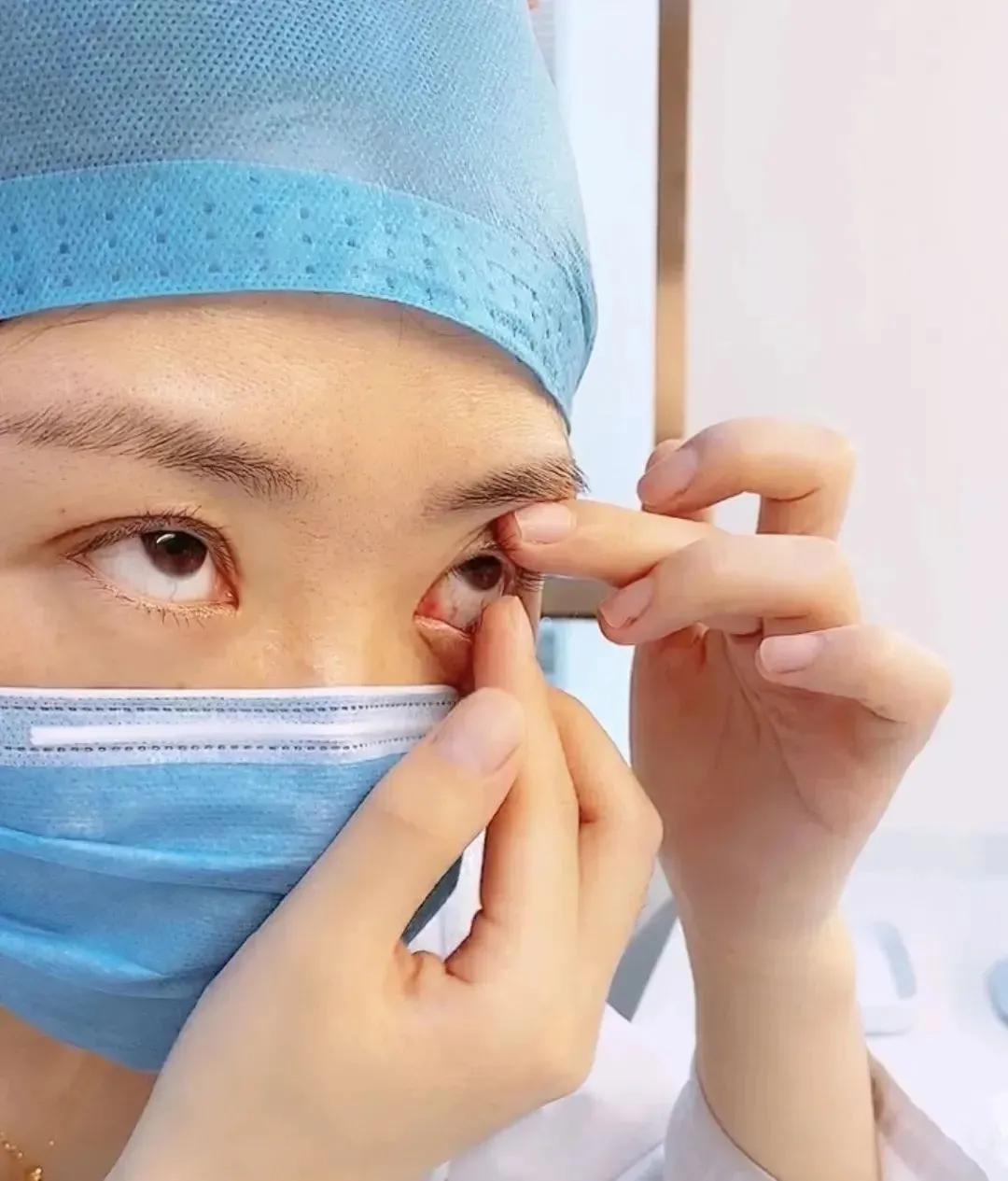 摘隐形眼镜有什么好方法吗,眼科医生告诉你隐形眼镜戴法