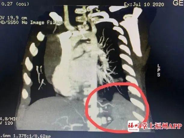 小孩咳嗽发烧已经3天,5个月宝宝咳嗽反复发烧38.5