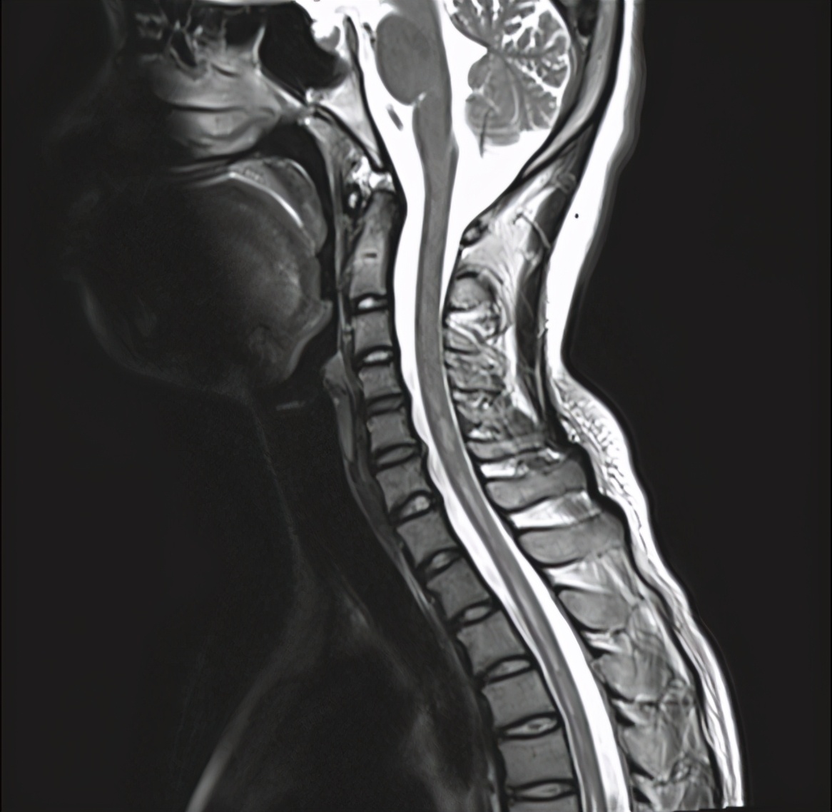 小孩淋巴结核肿大怎么办,儿童淋巴结结核如何治疗