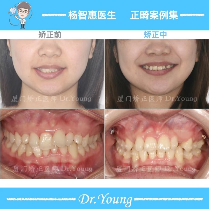 牙齿矫正牙列不齐案例,厦门儿童牙齿矫正龅牙前突