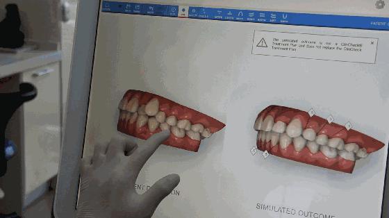 牙齿矫正你还在等什么,牙齿矫正对你最大的改变