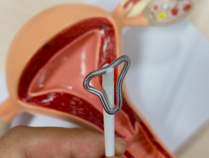 避孕环、节育环、宫内节育器,到底是个啥?