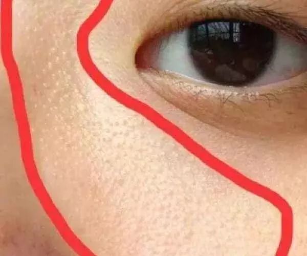 下巴挤出小米粒样的东西,下巴闭口挤出来的东西臭