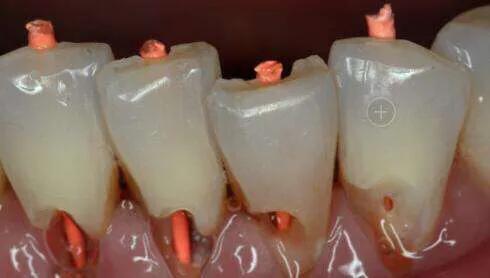 刷牙导致楔状缺损,楔状缺损刷牙牙龈痛