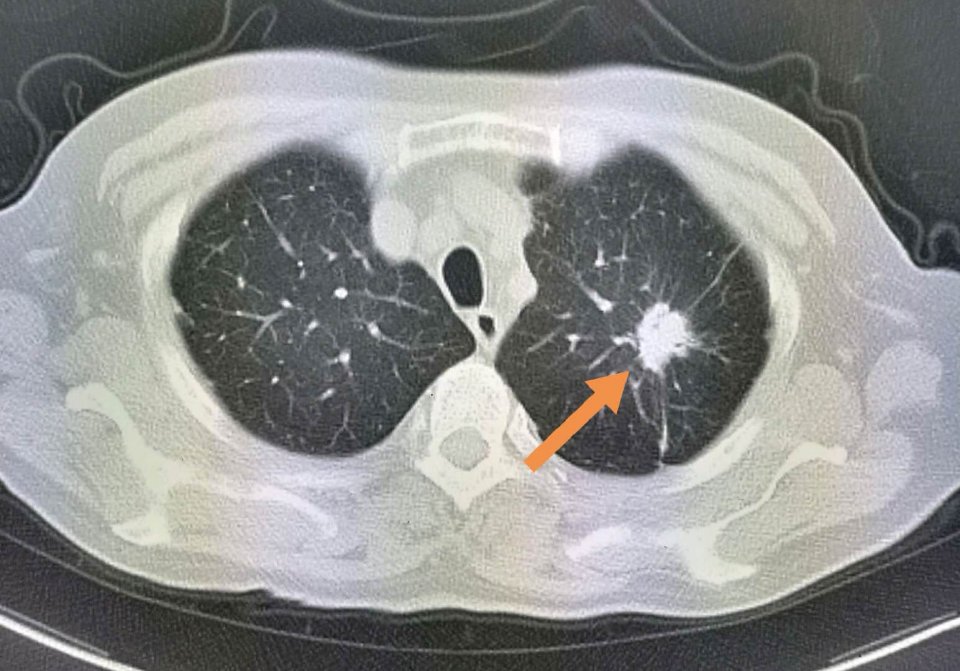 年年体检为啥查出癌症,每年正常体检能检查出肺癌吗