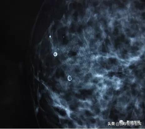 乳腺钙化怎么区分良性和恶性,乳腺钙化的诊断与分级