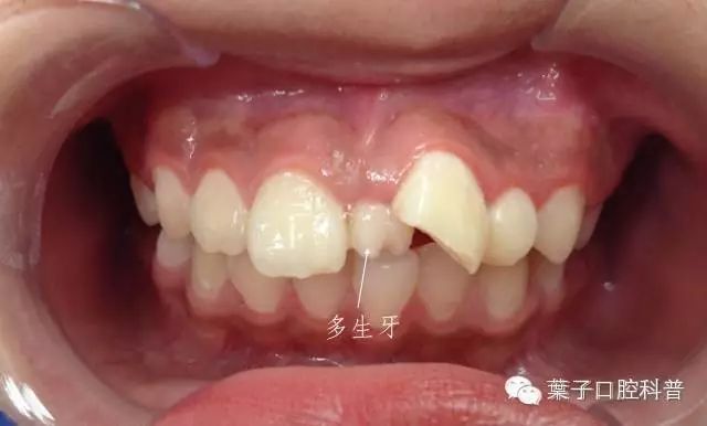 孩子多余的牙齿什么年龄适合拔掉,小孩子的牙齿需要填补吗