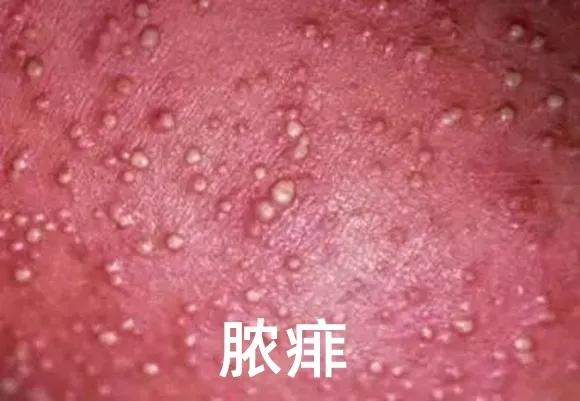 爽身粉去痱子,爽身粉止痒祛痱成人