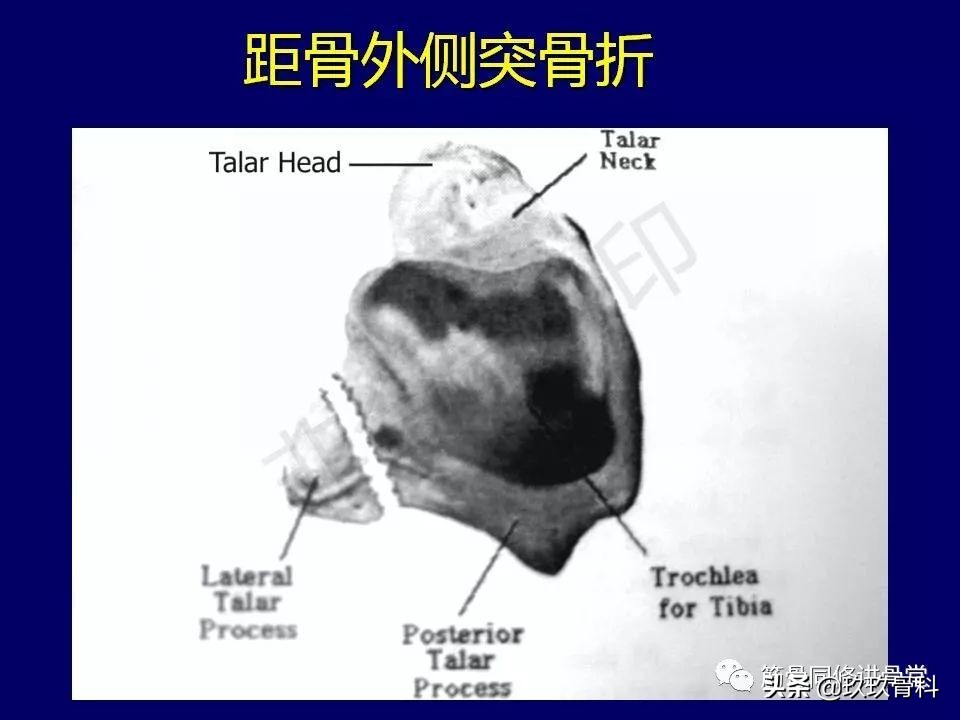 距骨骨折后遗症,距骨骨折怎么办